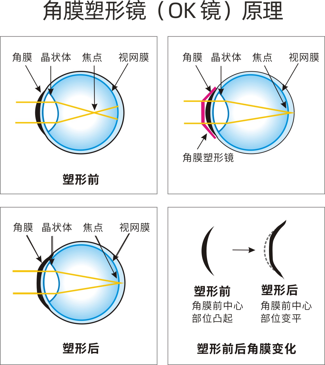 20210406角膜塑形镜画册（曲）.jpg